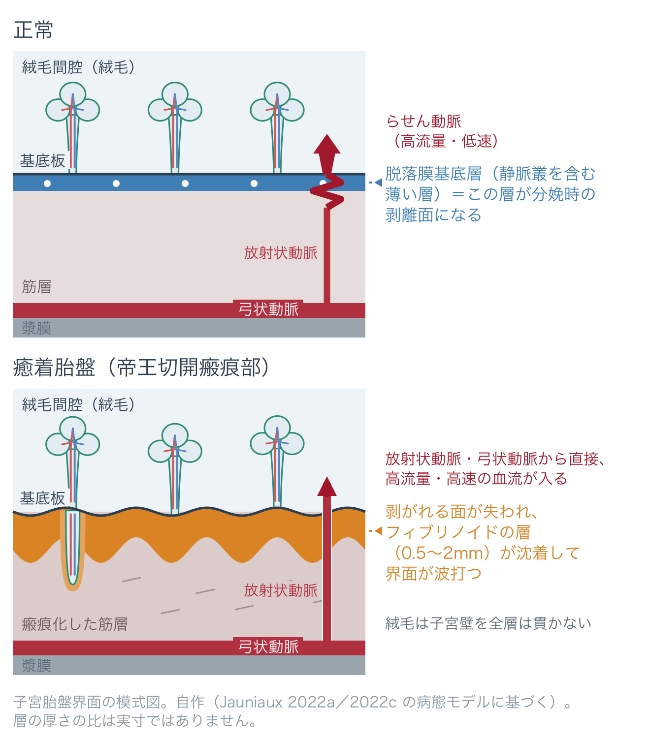 図1 子宮胎盤界面の模式図（上＝正常、下＝帝王切開瘢痕部の癒着胎盤）。正常では基底板と筋層のあいだに静脈叢を含む薄い脱落