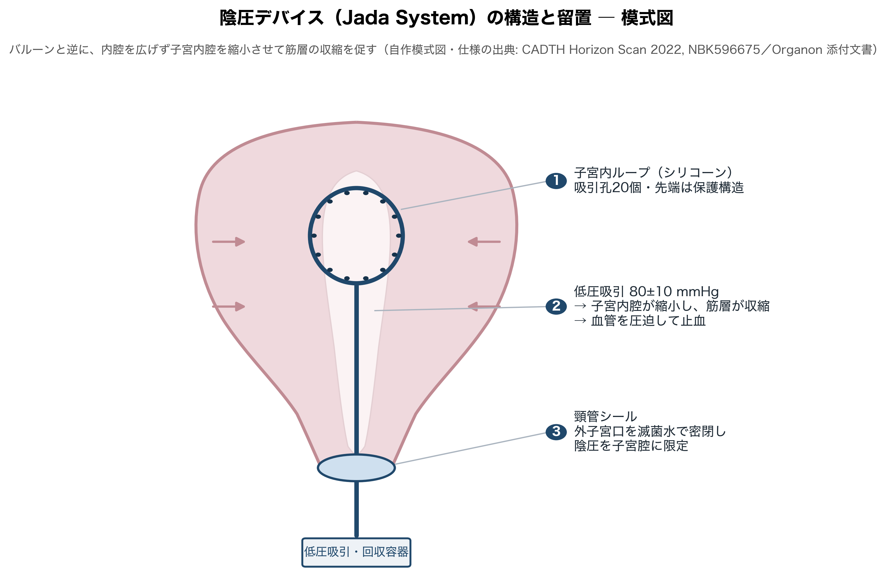 参考図 陰圧デバイス（Jada System）の構造と留置の模式図（自作。仕様の出典＝CADTH Horizon Sca